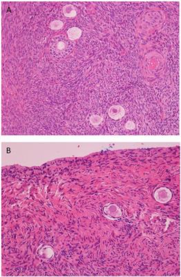 Fertility Preservation in Endometriosis Patients: Anti-Müllerian Hormone Is a Reliable Marker of the Ovarian Follicle Density